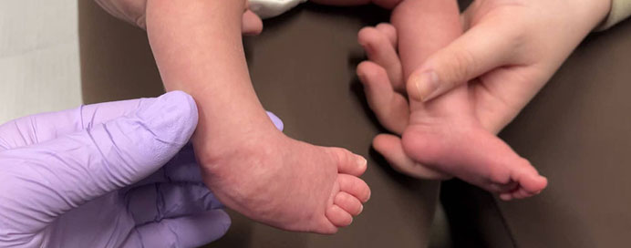 Clubfoot Treatment