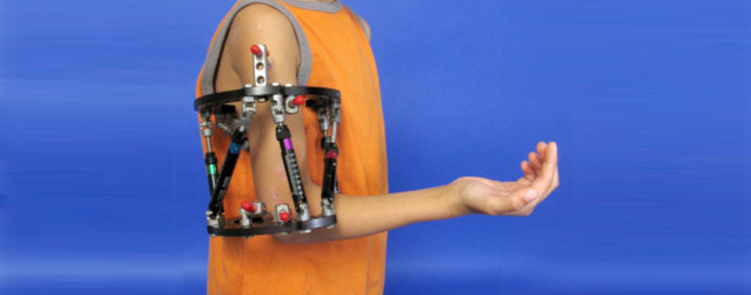Limb Lengthening with External Fixators