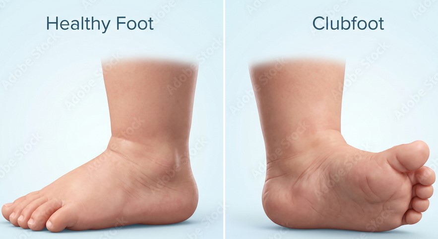 best clubfoot treatment doctor in Dombivli