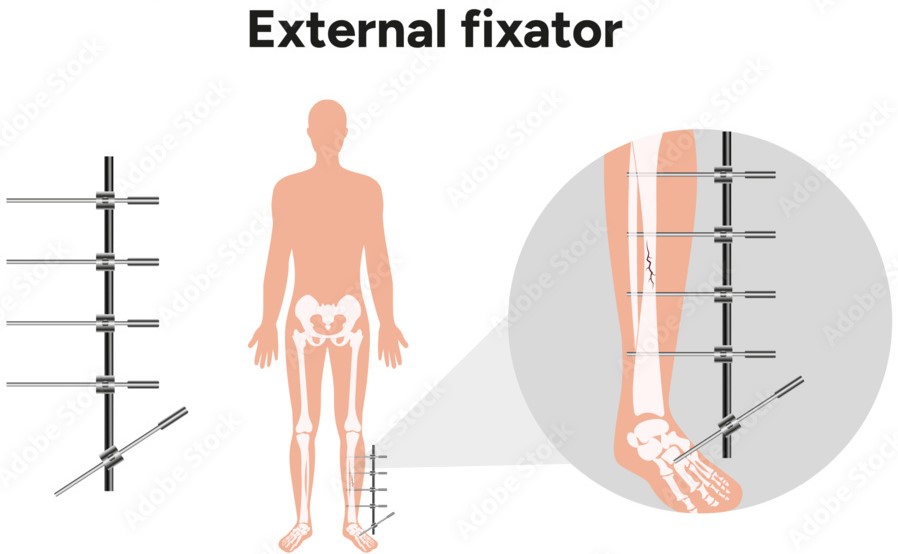 best limb lengthening surgeon in Dombivli